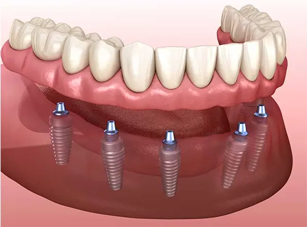 Dental-implants-process